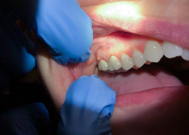 Best Emergency Dental Care for Abscessed Tooth in Farmersville, TX